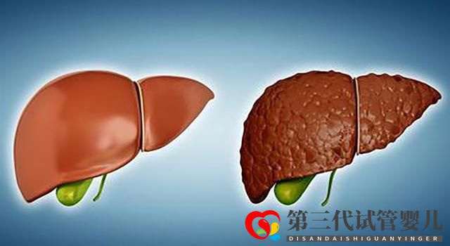 老年肝硬化的原因有哪些？醫(yī)生：多數(shù)可以避免(圖2)