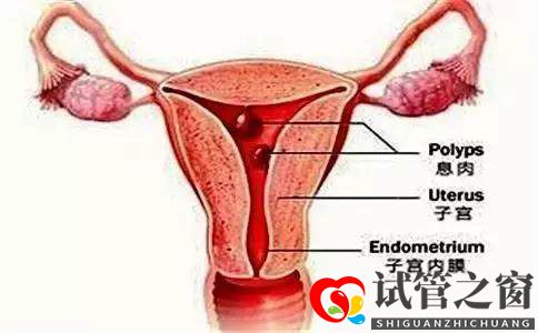 試管之窗:子宮內膜有息肉要切除才能做試管嬰兒嗎(圖2)