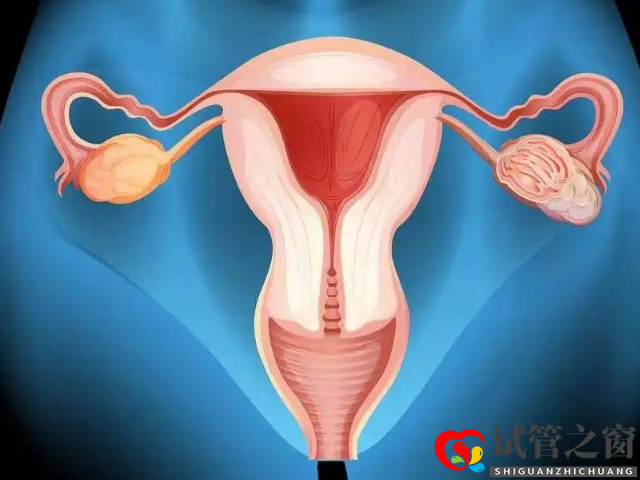 始基子宮是畸形子宮