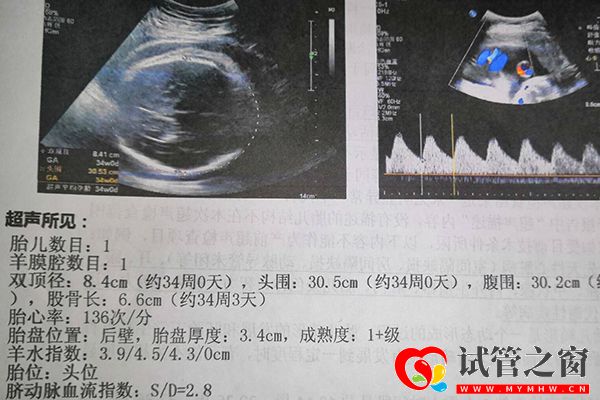 試管嬰兒一超確定胎兒是否宮內(nèi)妊娠