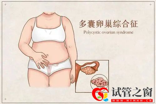 如何降低多囊卵巢的風險(圖1)