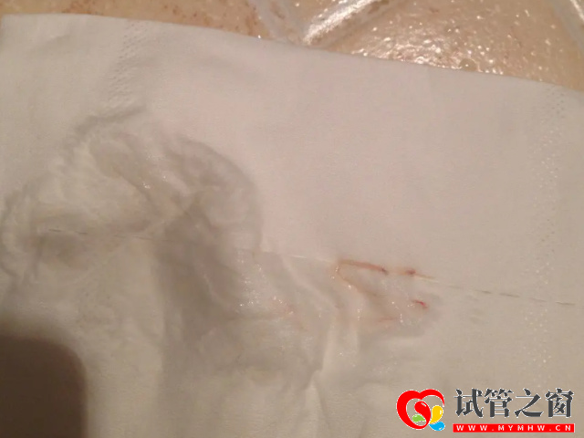 排卵期女性白帶量會增加