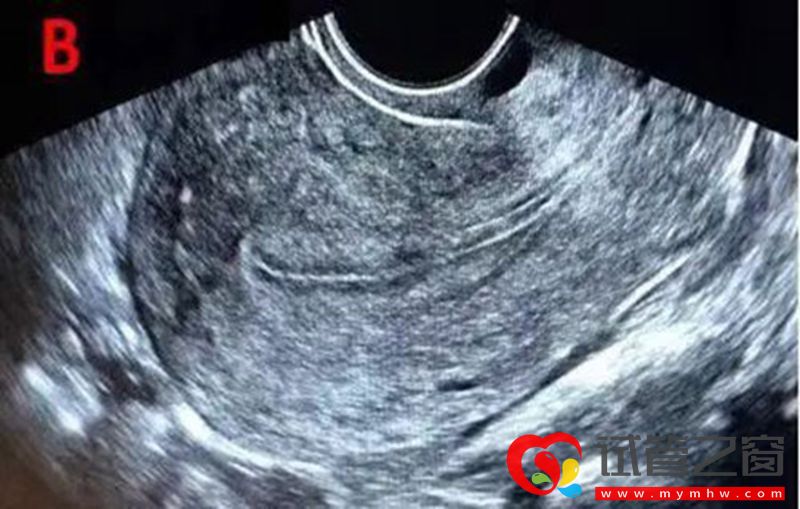 詳解B超監測排卵的那些事，助你交好“孕”(圖3)