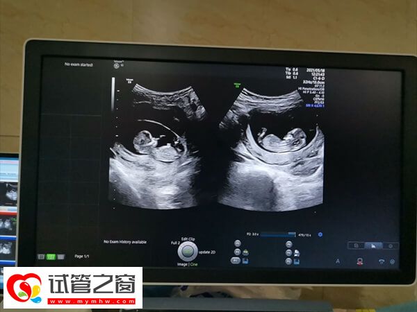 試管嬰兒可以生育雙胞胎