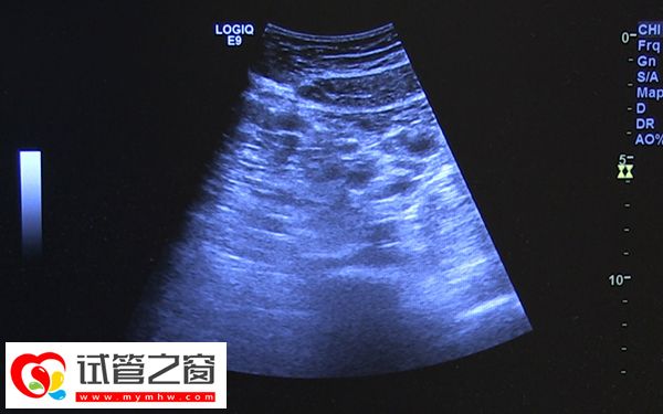 促排卵后出現5個成熟卵泡是正常的