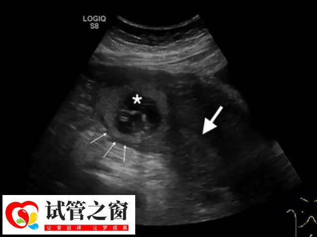 胚胎一般移植在子宮的中部