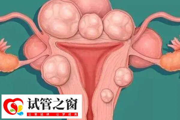 子宮肌瘤試管前可以進行治療