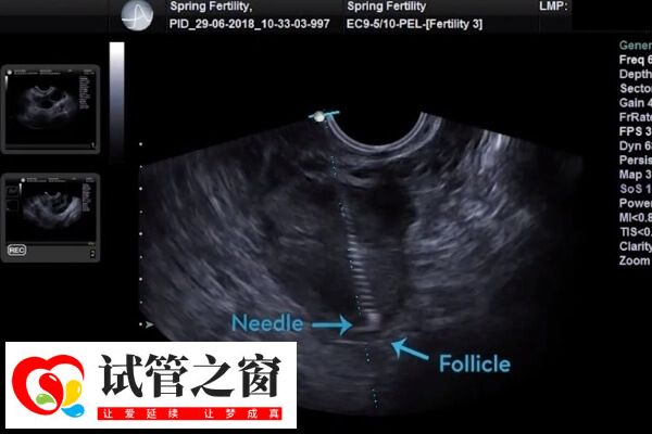 取卵后腹水要注意及時就醫
