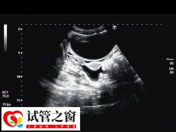 囊胚移植后會開始在子宮內漂浮