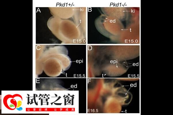 PKD1基因又叫多囊腎相關基因