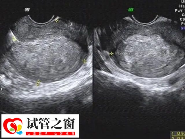 輸卵管積水產生的胚胎毒性作用
