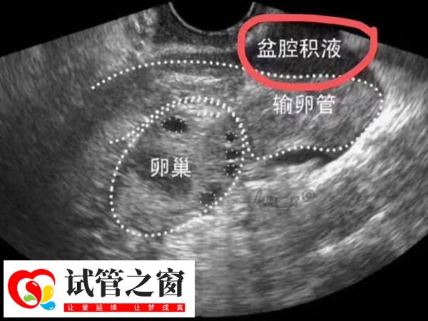 輸卵管積液中存在細菌和病毒等病原體