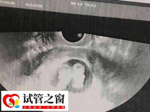 肺結核可能影響胚胎移植