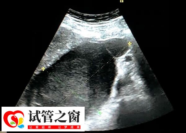 試管嬰兒移植后可能會(huì)感到腹部疼痛和不適