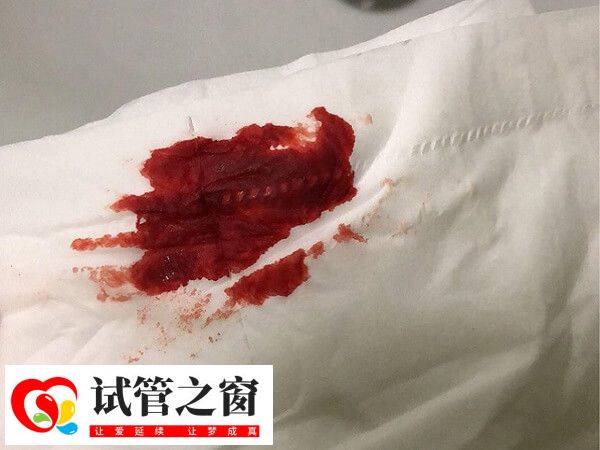 做試管受孕失敗后會(huì)有出血的情況