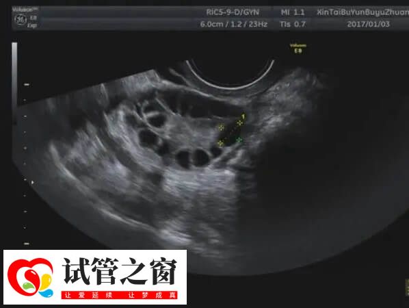 多囊卵巢為臨床常見的不孕癥