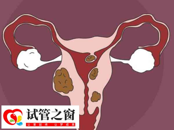 子宮肌瘤在促排期間注意密切監(jiān)測