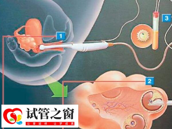 雙腔取卵和單腔取卵各有特點
