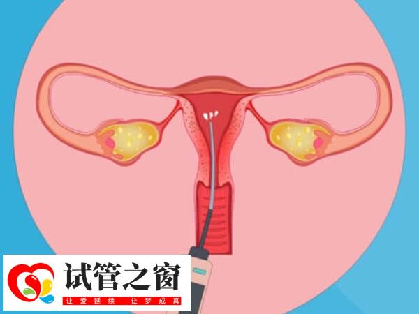盆腔結(jié)核能否做試管得看治療效果