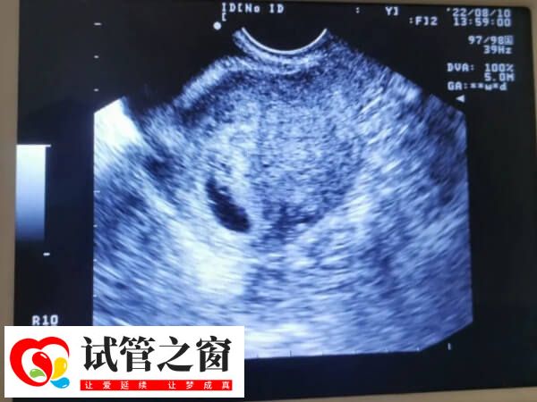 試管二超胎芽長度是否正常要看患者情況
